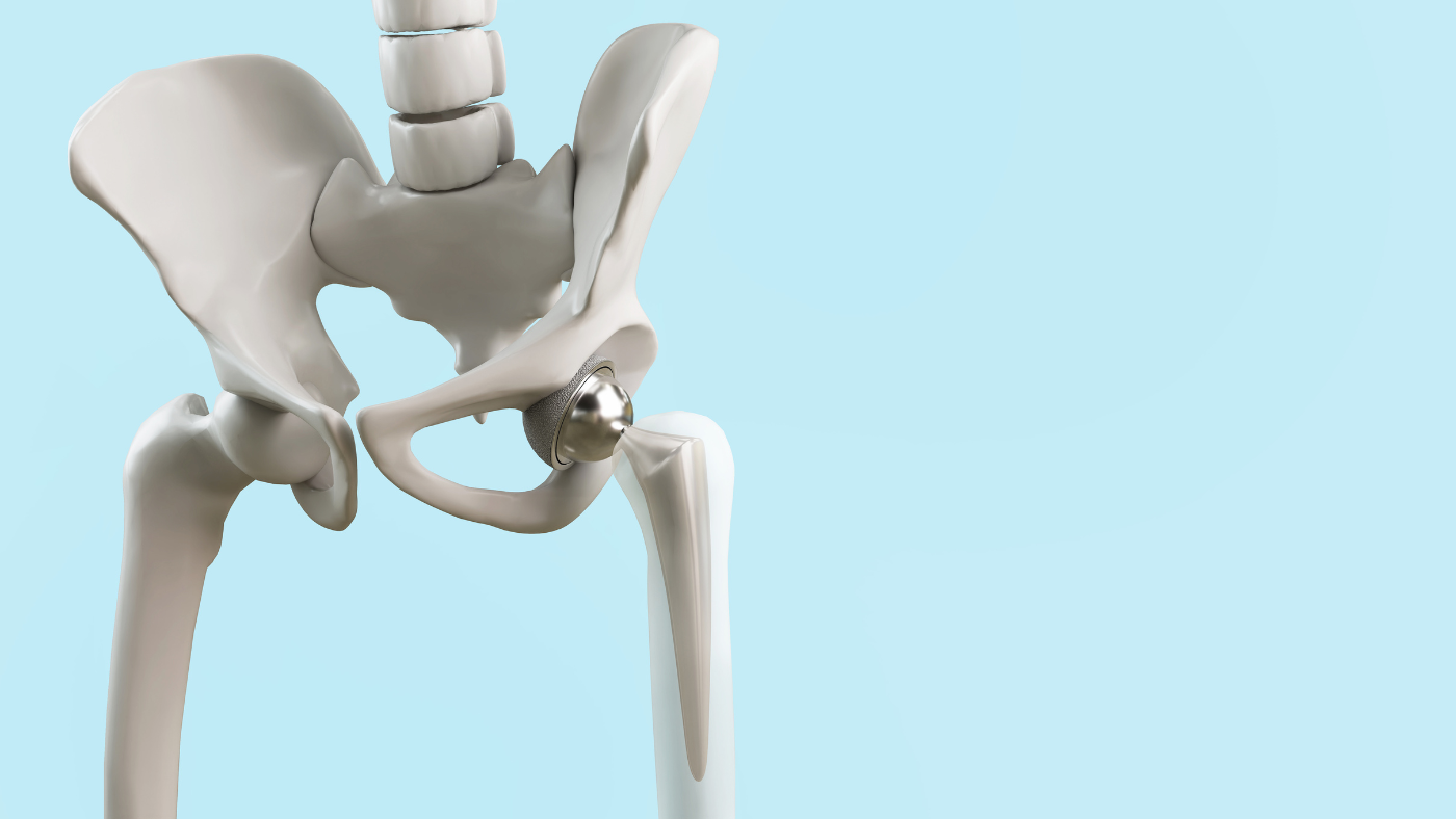 Hip replacement procedure